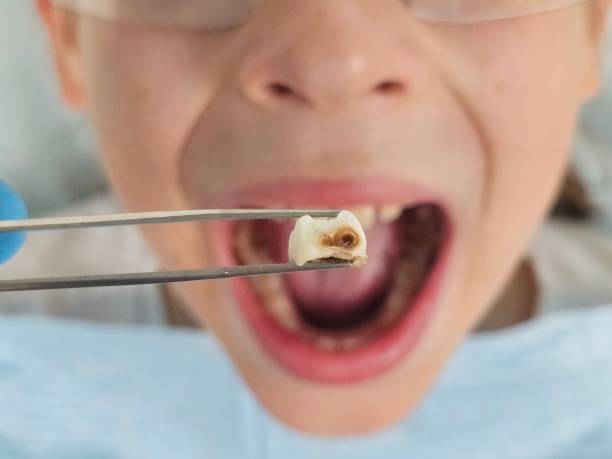 Best Emergency Treatment for Toothache in Glenshaw, PA
